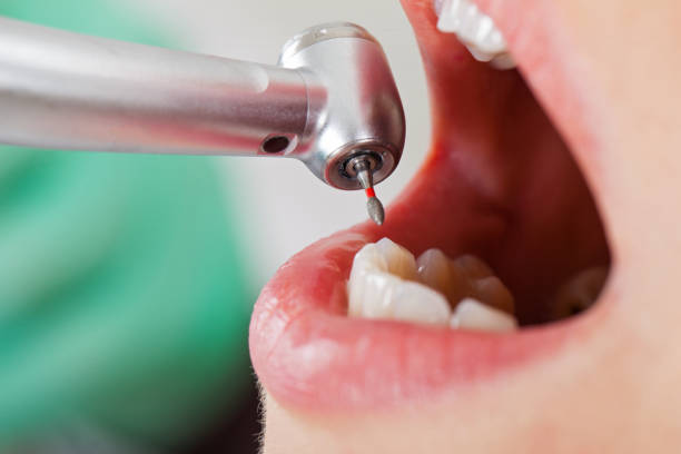 Best Dental Abscess Treatment in Lehi, UT